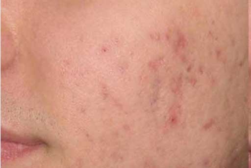 acne scar treatment