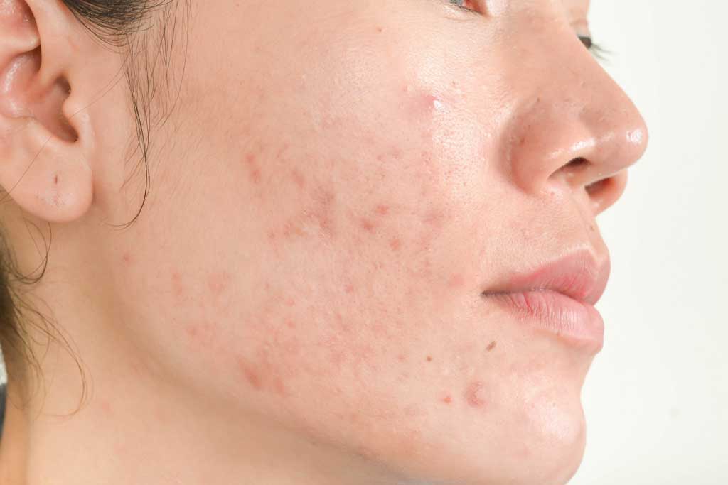 acne scar treatment