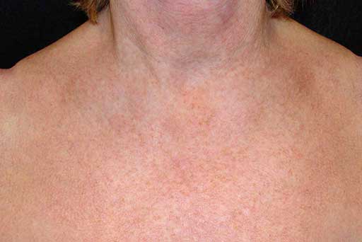 brown spots treatment