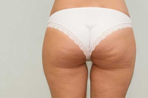 cellulite treatments