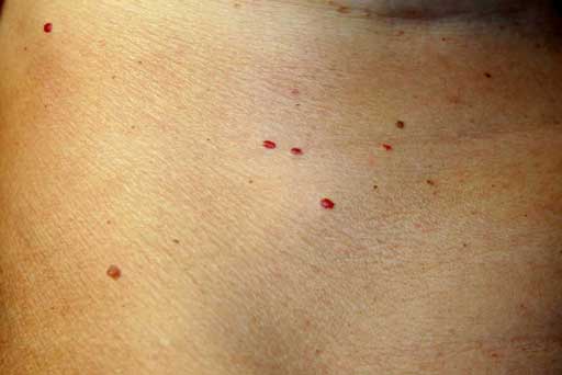 cherry angioma removal