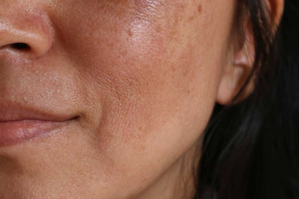 melasma treatment