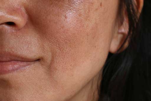 melasma treatment