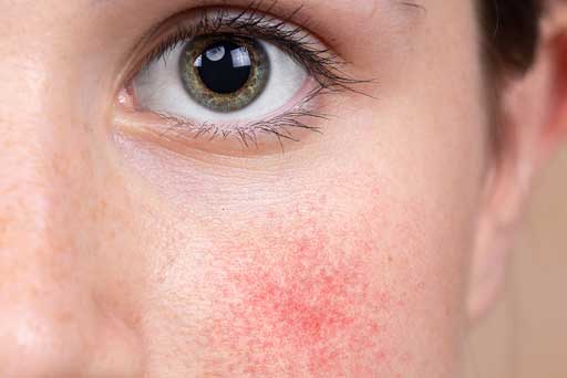 laser treatment for rosacea