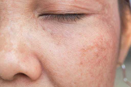 skin pigmentation treatment