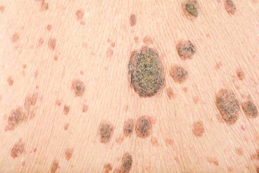 mole removal surrey