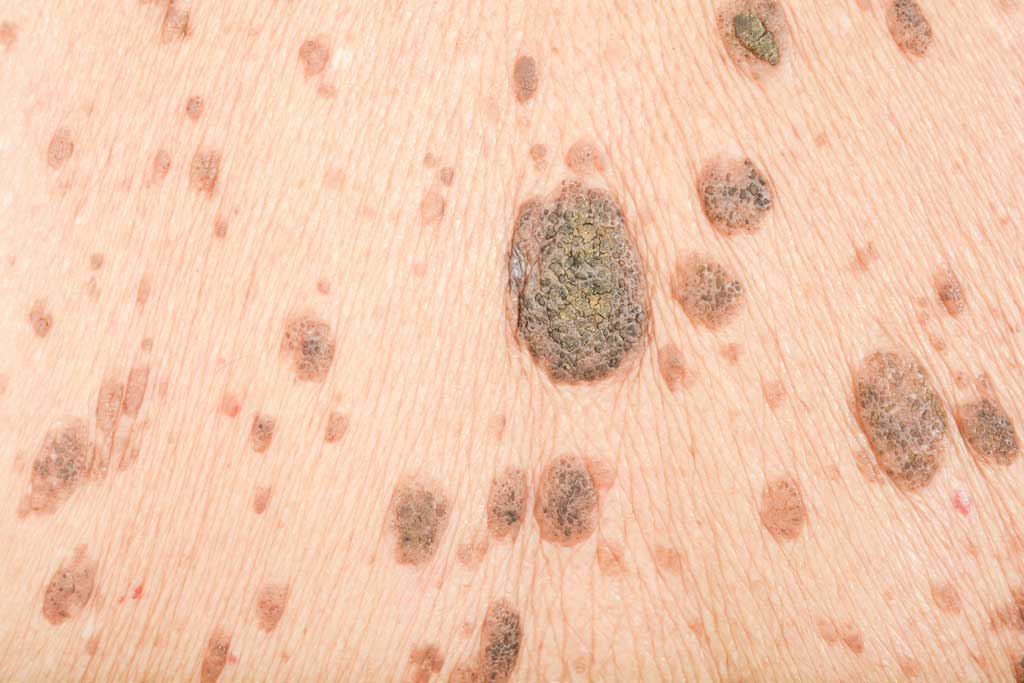 mole removal surrey