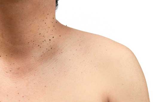 mole removal surrey