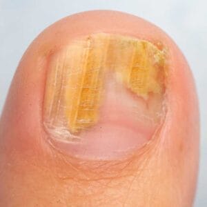 nail fungus laser treatment