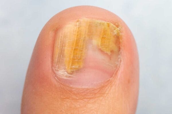 nail fungus laser treatment