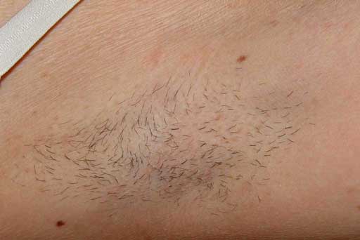 laser hair removal surrey