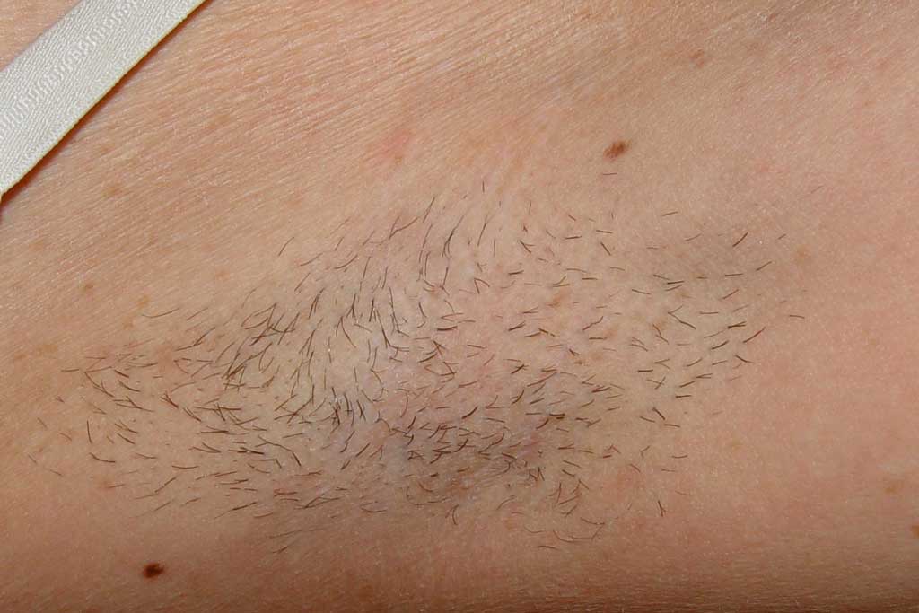 laser hair removal surrey