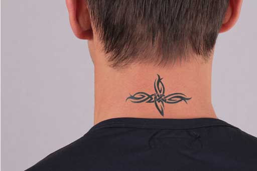 tattoo removal surrey