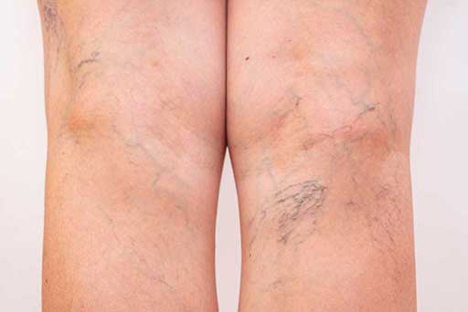 laser spider veins