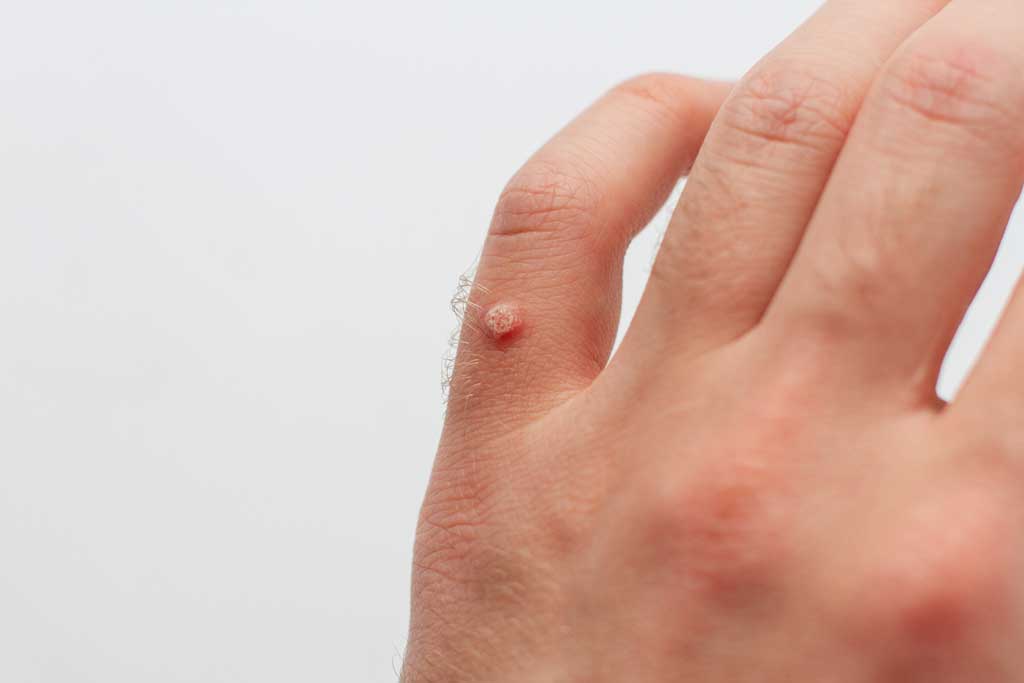 wart removal surrey