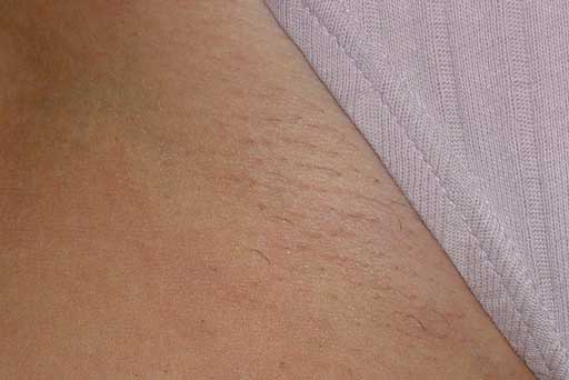 laser hair removal surrey