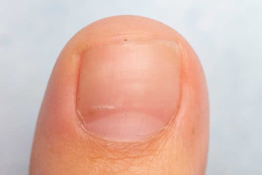 nail fungus treatment