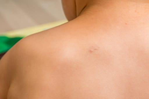 cherry angioma removal