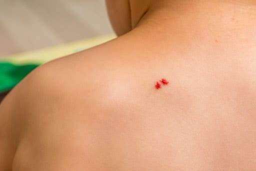 cherry angioma removal