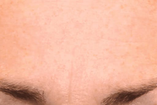 microneedling