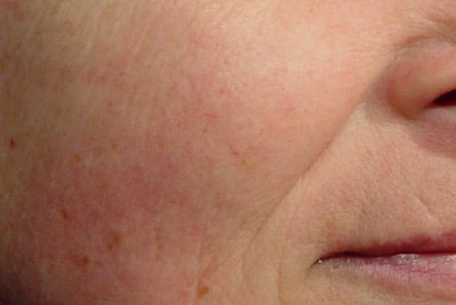 laser genesis surrey