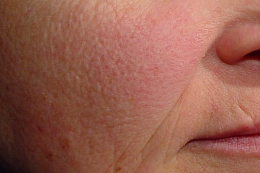 laser genesis surrey