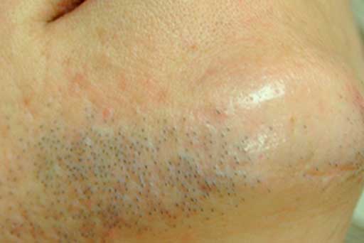 laser hair removal surrey