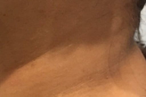 mole removal surrey