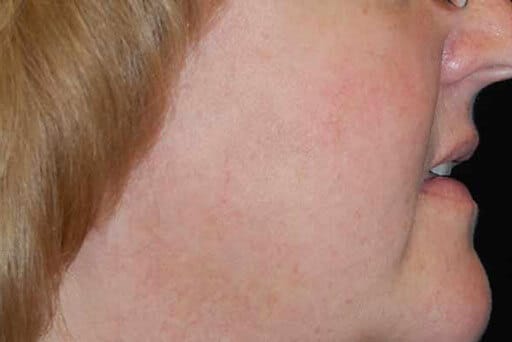 laser genesis surrey