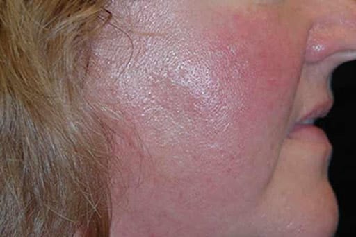 laser genesis surrey