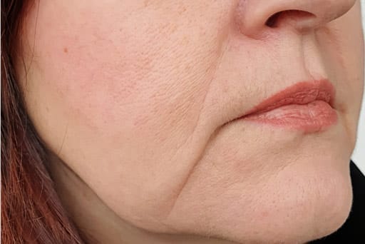 sagging skin treatment