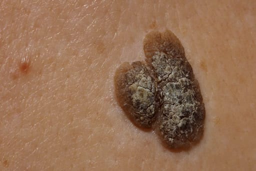 mole removal surrey