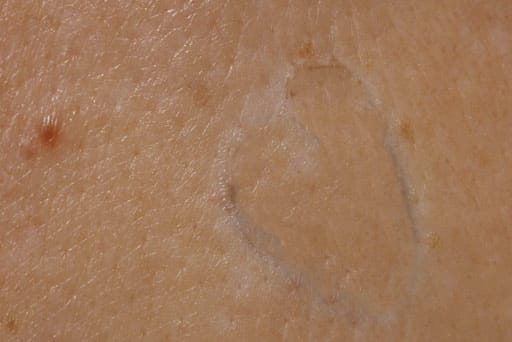 mole removal surrey