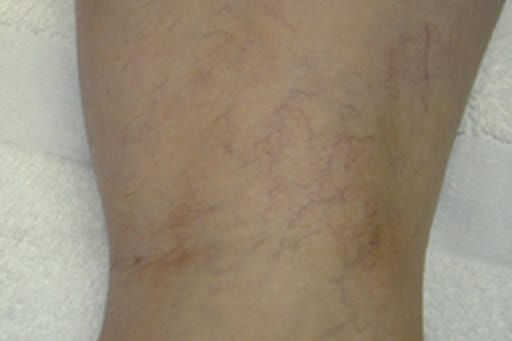 laser spider veins