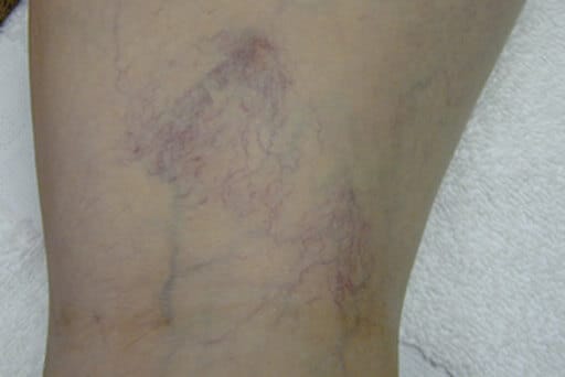 laser spider veins