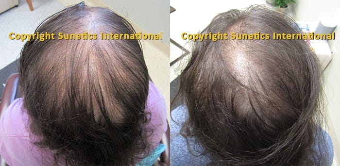 laser hair regrowth