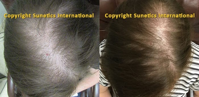 laser hair regrowth