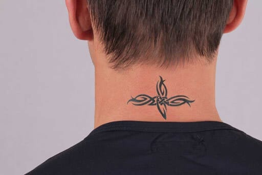tattoo removal surrey