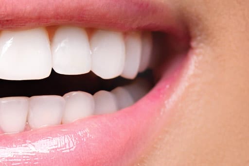 teeth whitening surrey