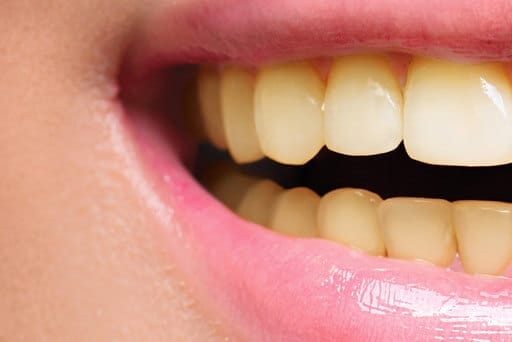 teeth whitening surrey
