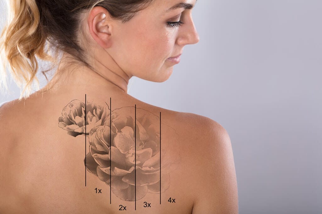 tattoo removal surrey