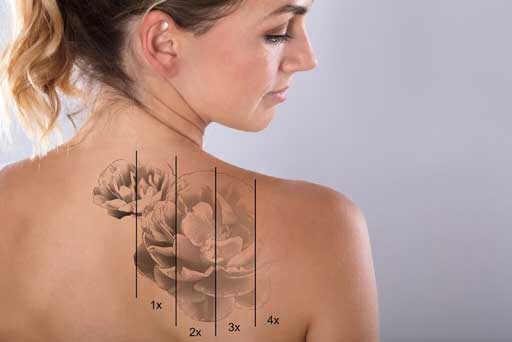 tattoo removal surrey