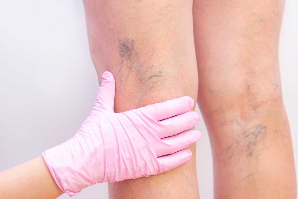 laser vein removal