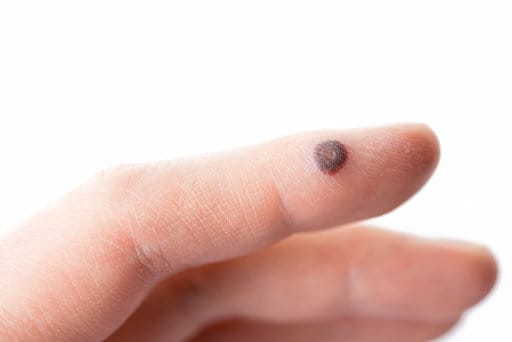 wart removal surrey