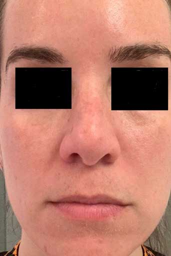 Chemical Peel After