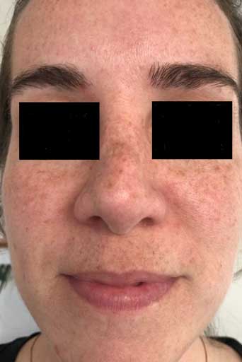 chemical peel surrey bc