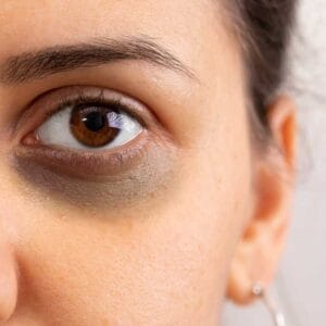 dark circles eye treatment