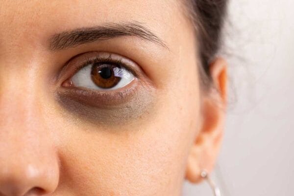 dark circles eye treatment