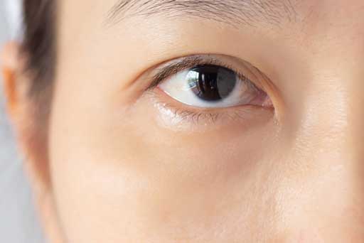 dark circles eye treatment
