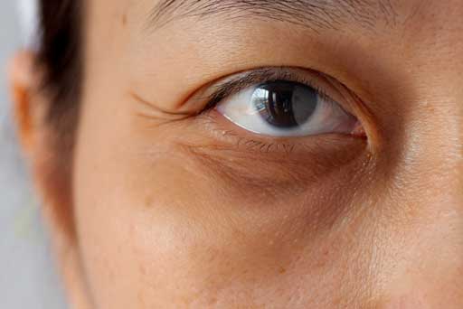 dark circles eye treatment